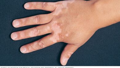 Vitiligo causes and treatment