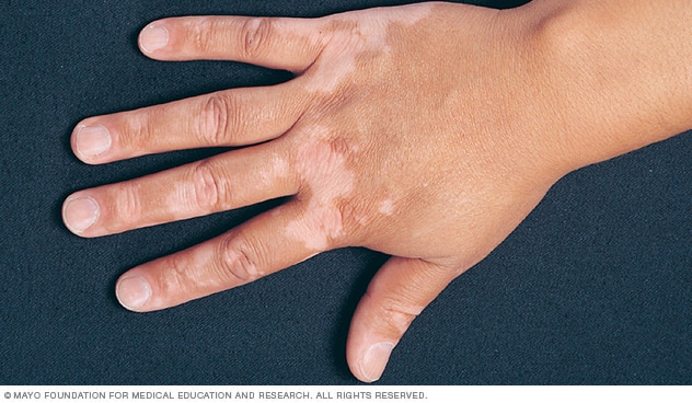 Vitiligo causes and treatment