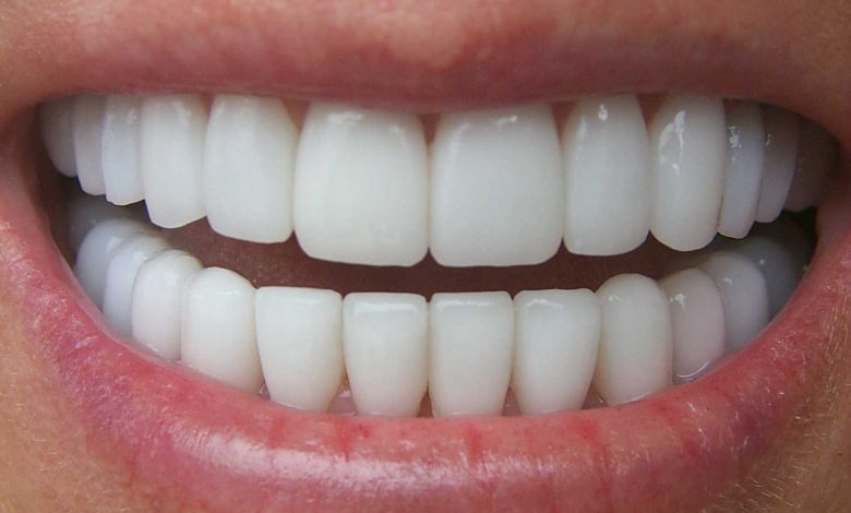 temporary veneers
