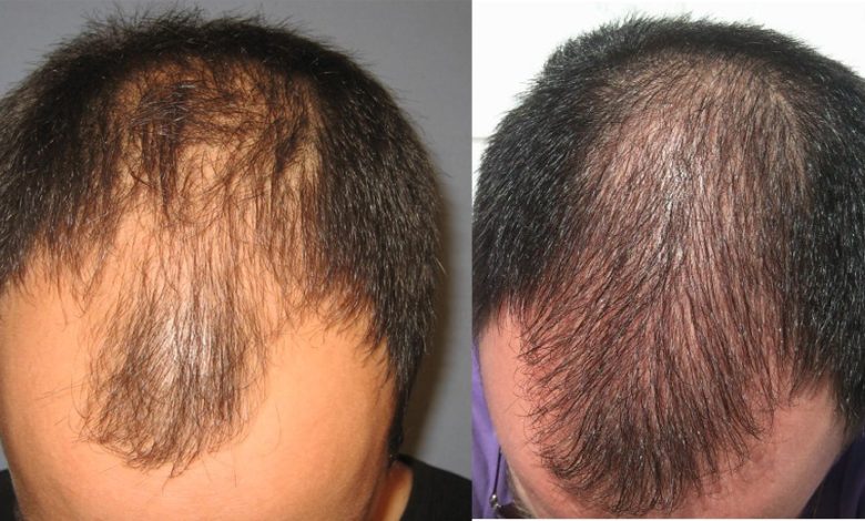 HAIR LOSS TREATMENT AND DIAGNOSIS